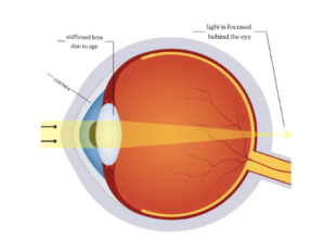 What Is Presbyopia? - ShowerSpecs/Clearspecs